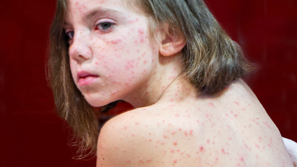 | Measles spreads very easily among those who are unvaccinated. Image: Adobe.